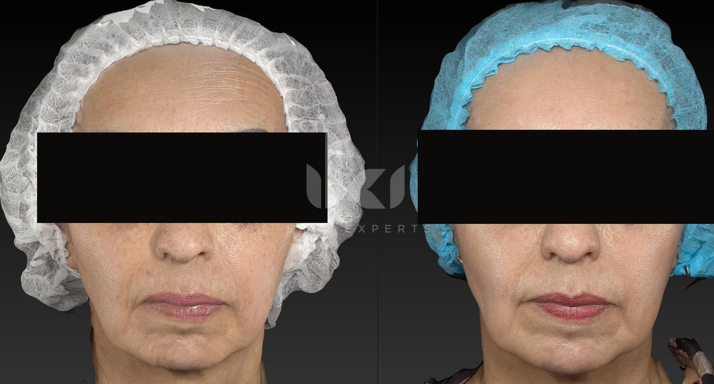 Antes y después de manchas y melasma en IKI Skin Experts, caso 46, identidad protegida