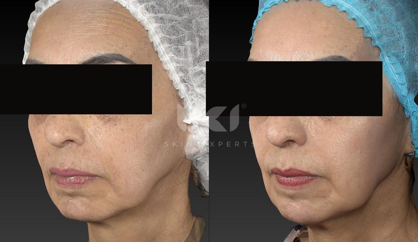 Antes y después de manchas y melasma en IKI Skin Experts, caso 47, identidad protegida