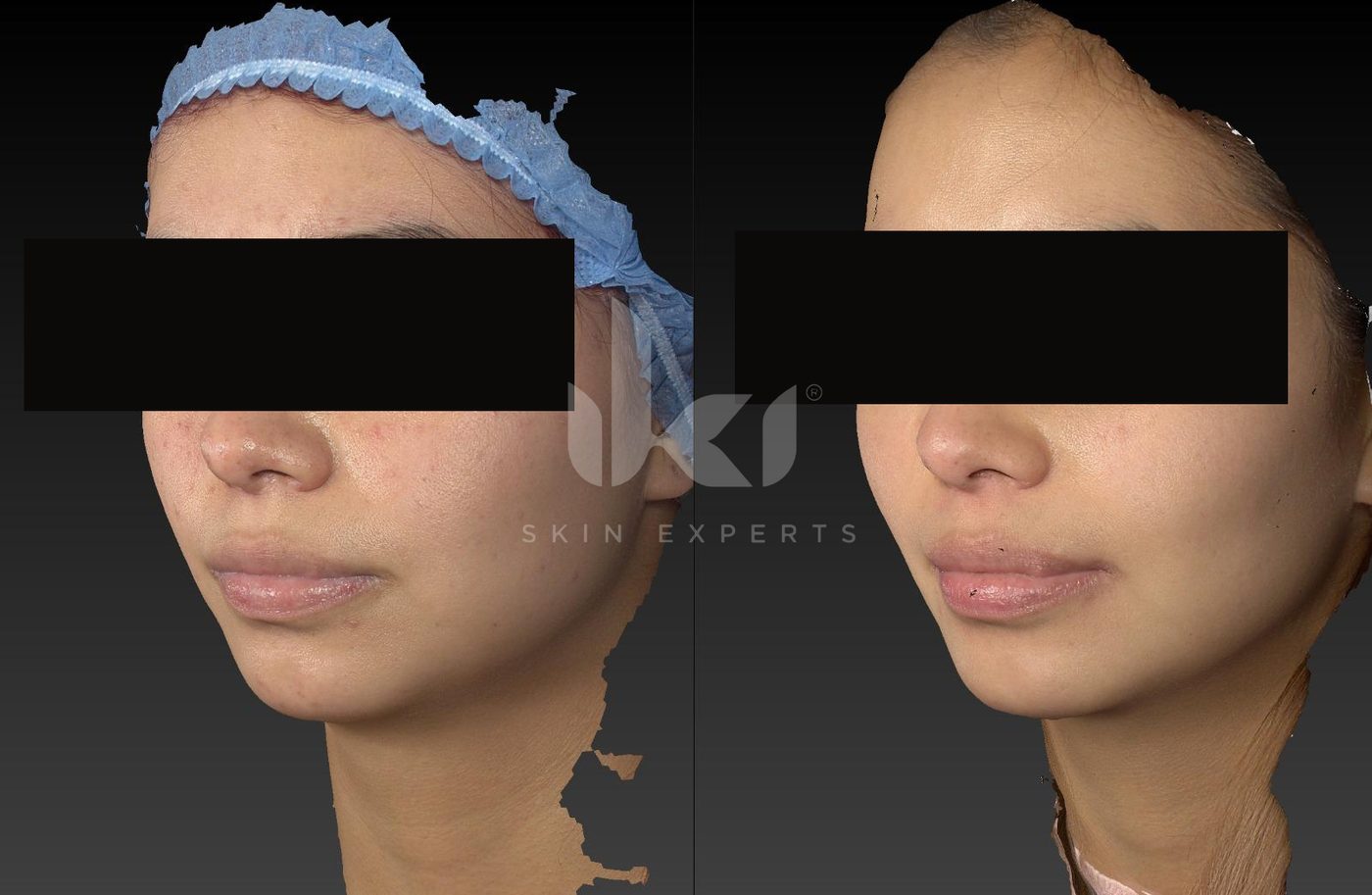 Antes y después de acné en IKI Skin Experts, caso 10, identidad protegida