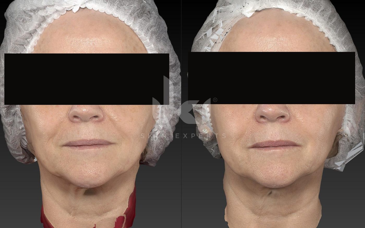 Antes y después de otros casos en IKI Skin Experts, caso 10, identidad protegida