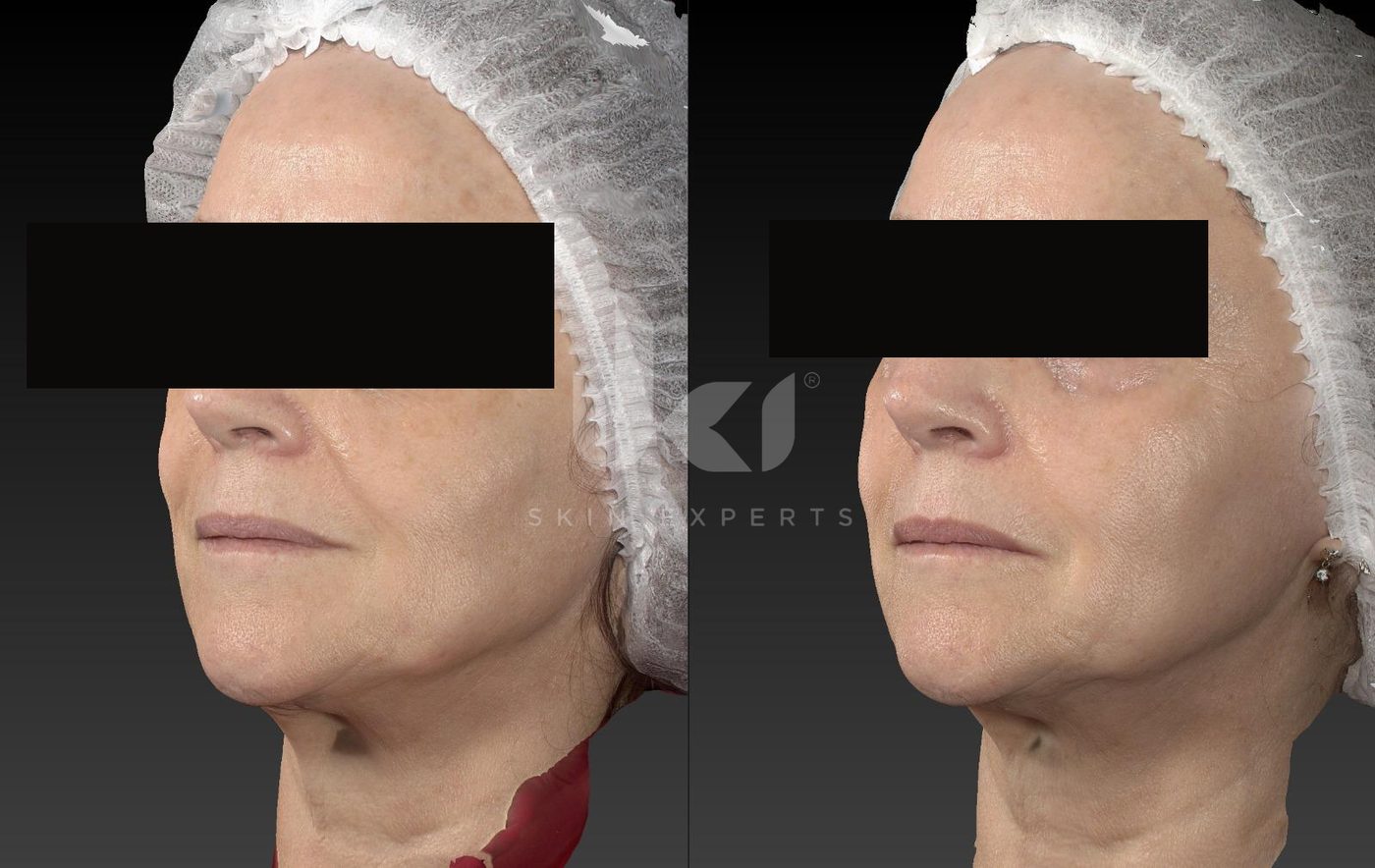 Antes y después de otros casos en IKI Skin Experts, caso 11, identidad protegida