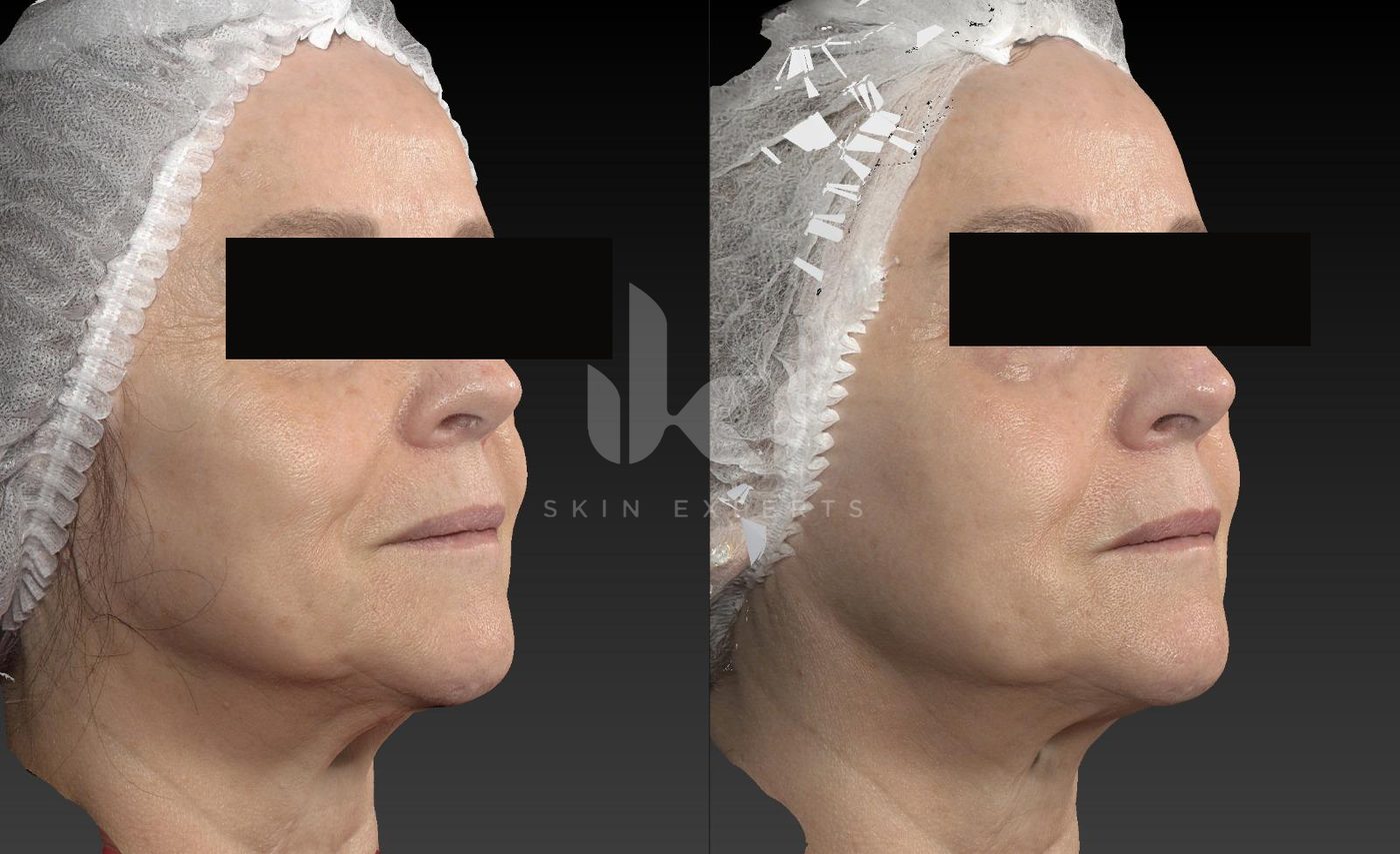 Antes y después de otros casos en IKI Skin Experts, caso 12, identidad protegida