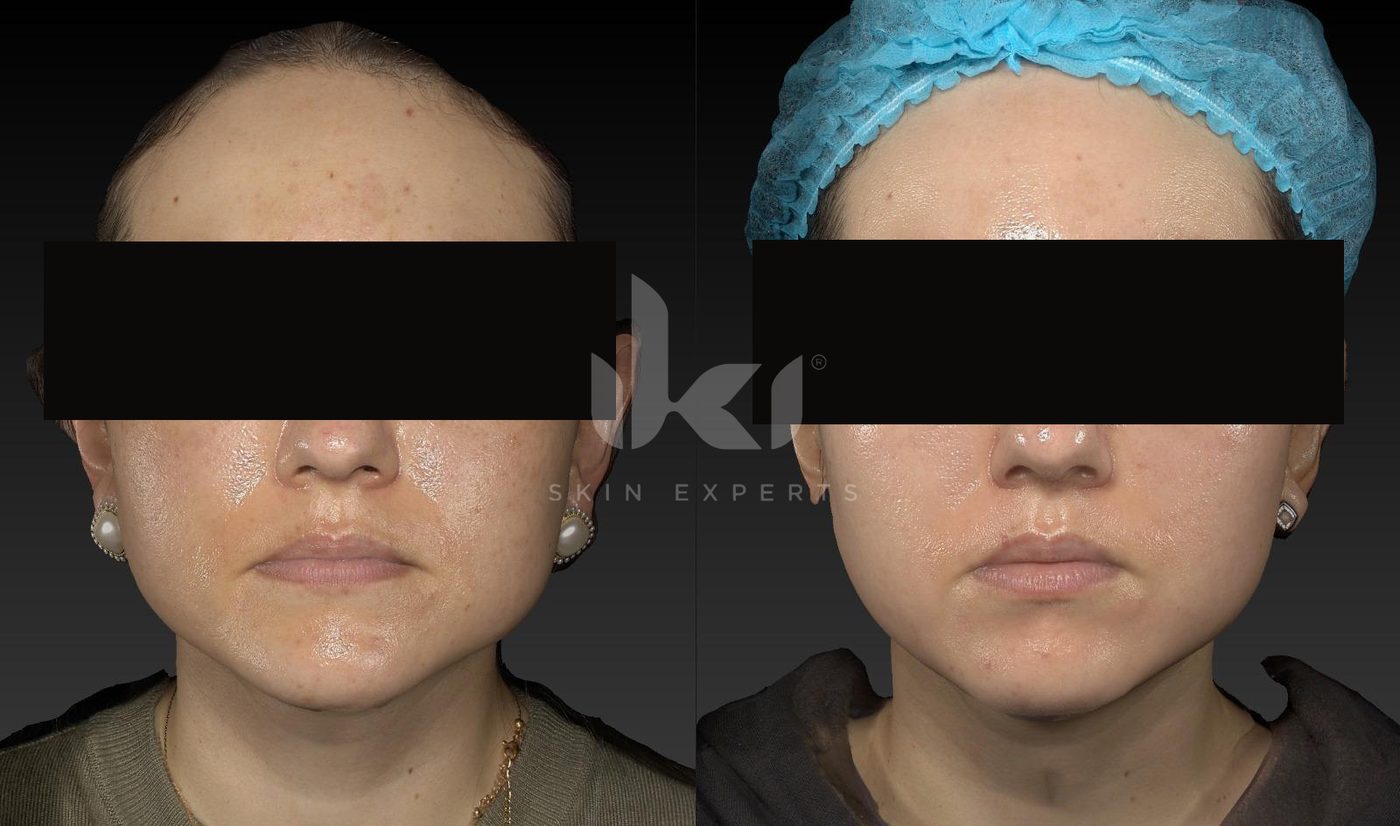 Antes y después de manchas y melasma en IKI Skin Experts, caso 48, identidad protegida