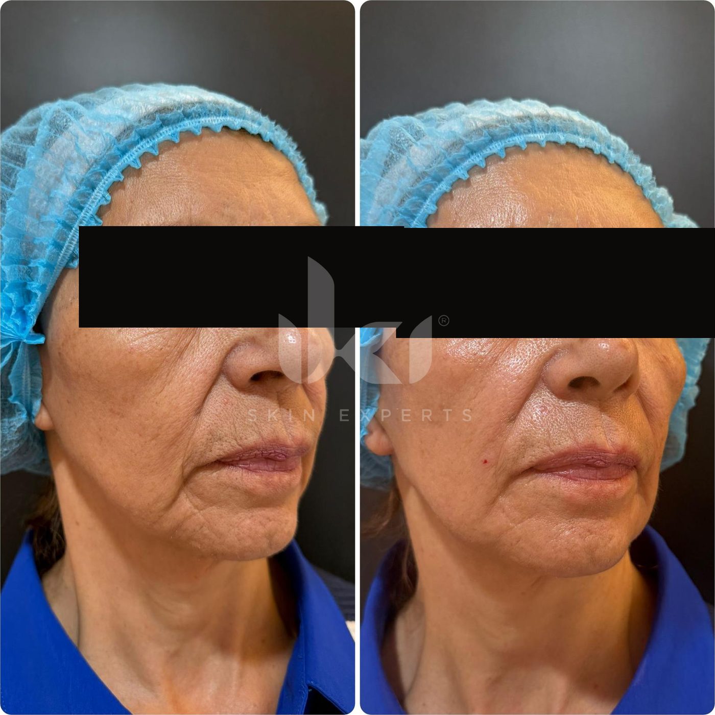 Antes y después de hifu · flacidez en IKI Skin Experts, caso 14, identidad protegida