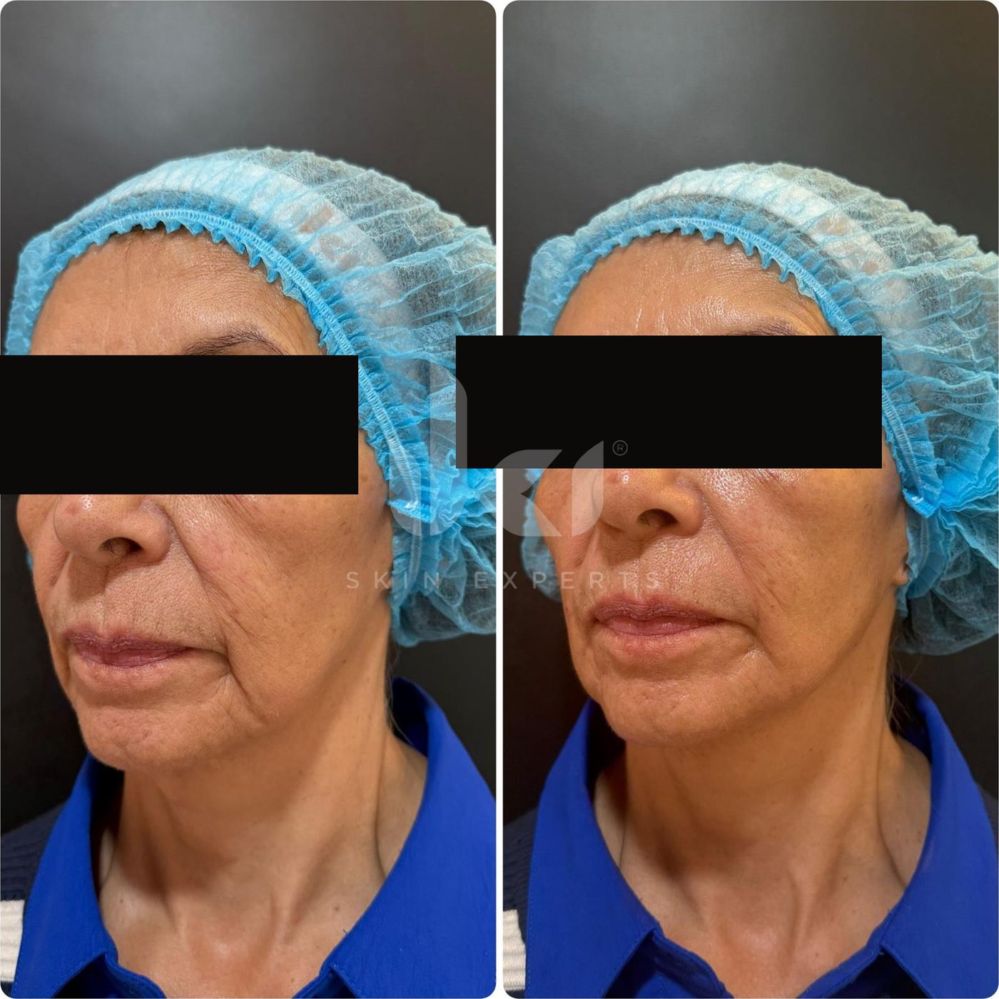 Antes y después de hifu · flacidez en IKI Skin Experts, caso 15, identidad protegida