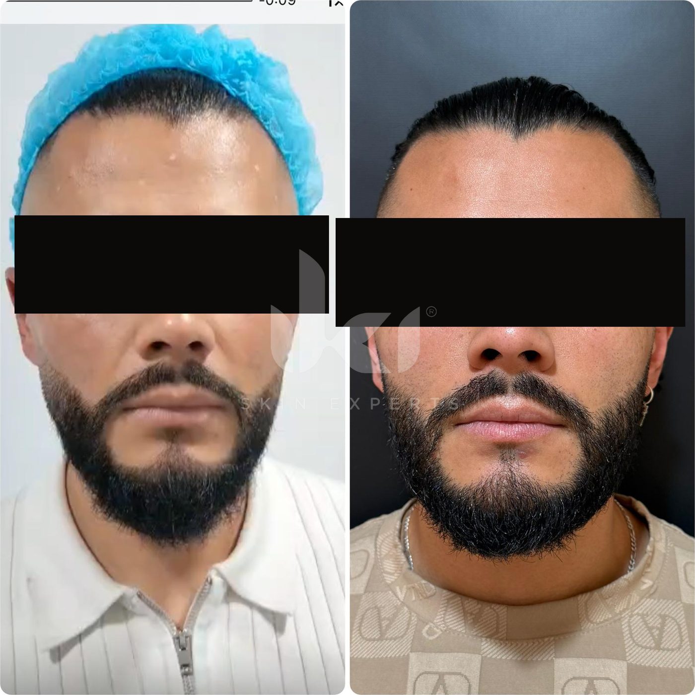 Antes y después de otros casos en IKI Skin Experts, caso 13, identidad protegida