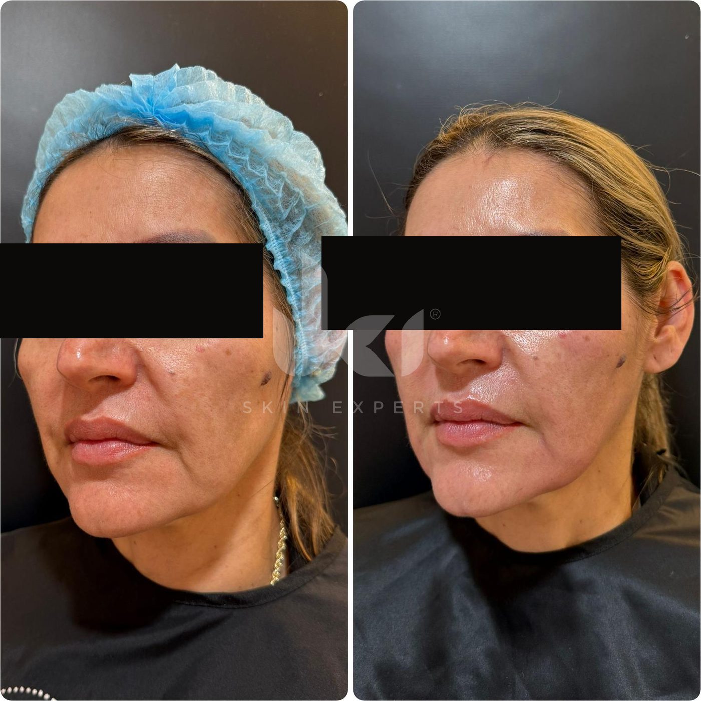 Antes y después de hifu · flacidez en IKI Skin Experts, caso 16, identidad protegida