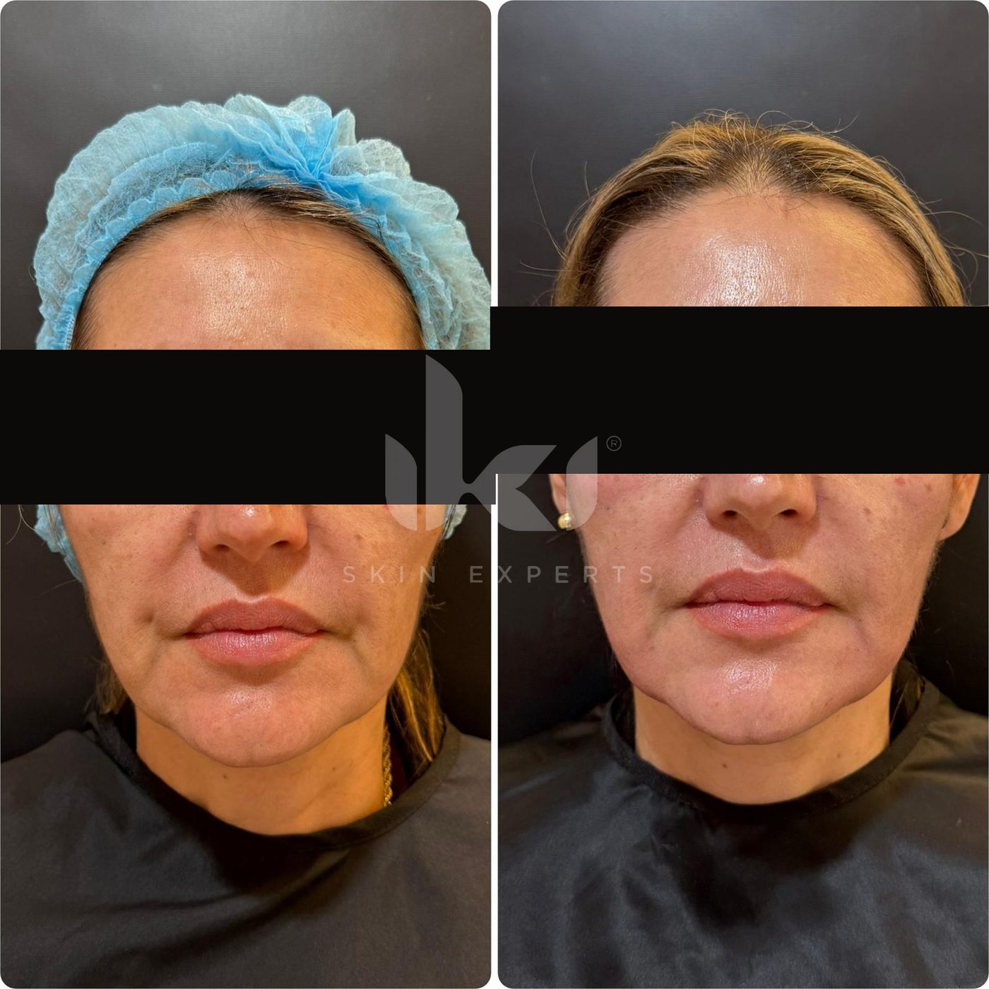 Antes y después de hifu · flacidez en IKI Skin Experts, caso 17, identidad protegida