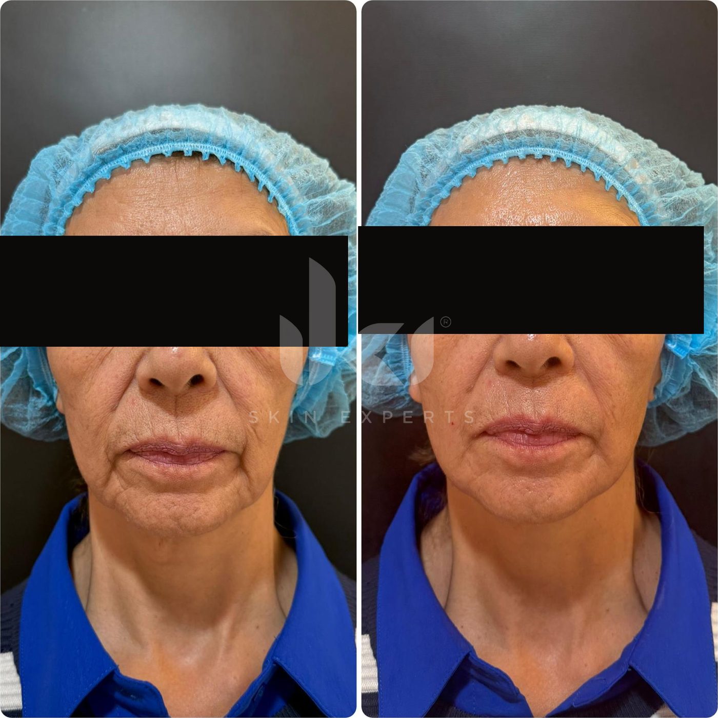 Antes y después de hifu · flacidez en IKI Skin Experts, caso 18, identidad protegida