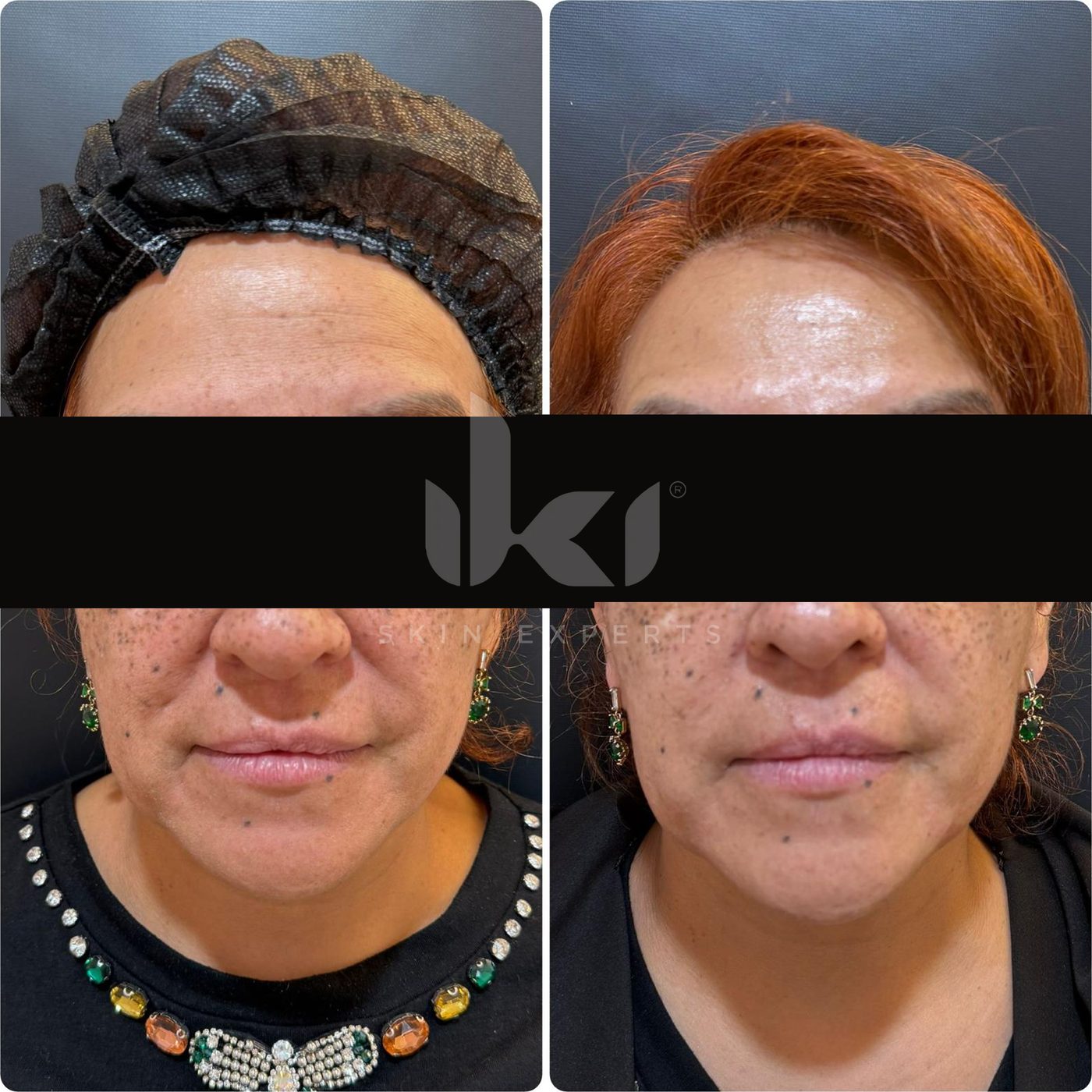 Antes y después de manchas y melasma en IKI Skin Experts, caso 49, identidad protegida