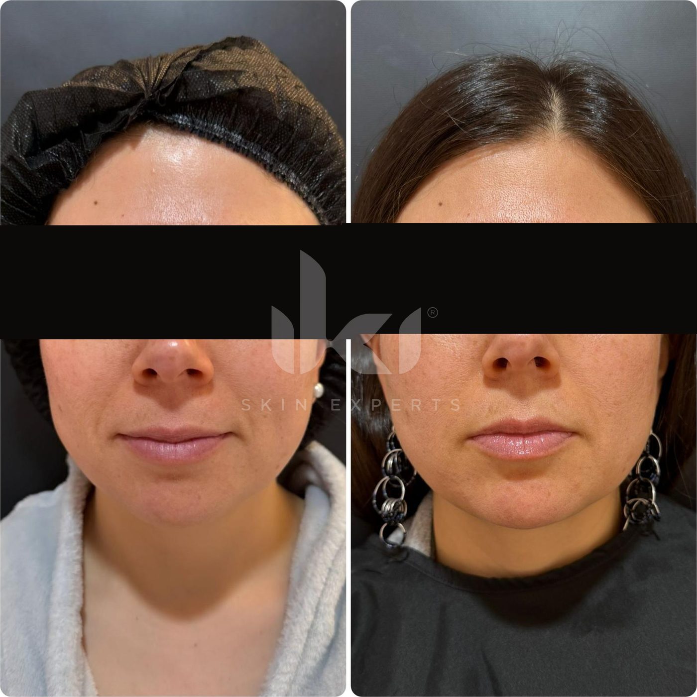 Antes y después de facial médico · hydrafacial en IKI Skin Experts, caso 13, identidad protegida