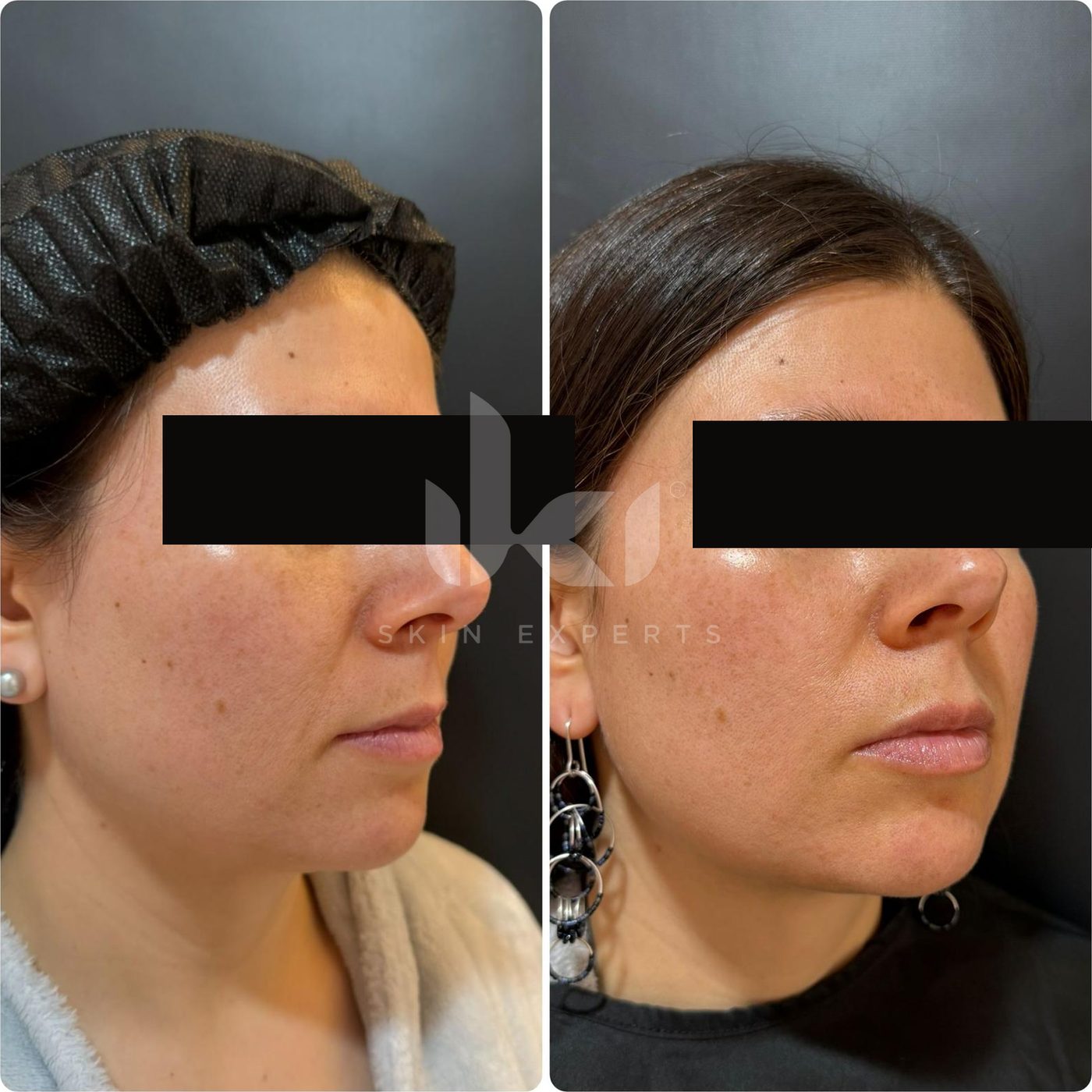 Antes y después de facial médico · hydrafacial en IKI Skin Experts, caso 14, identidad protegida