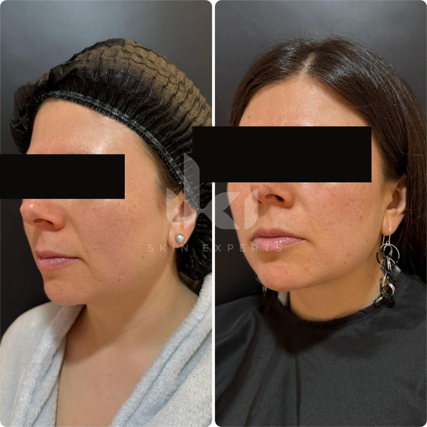 Antes y después de facial médico · hydrafacial en IKI Skin Experts, caso 15, identidad protegida