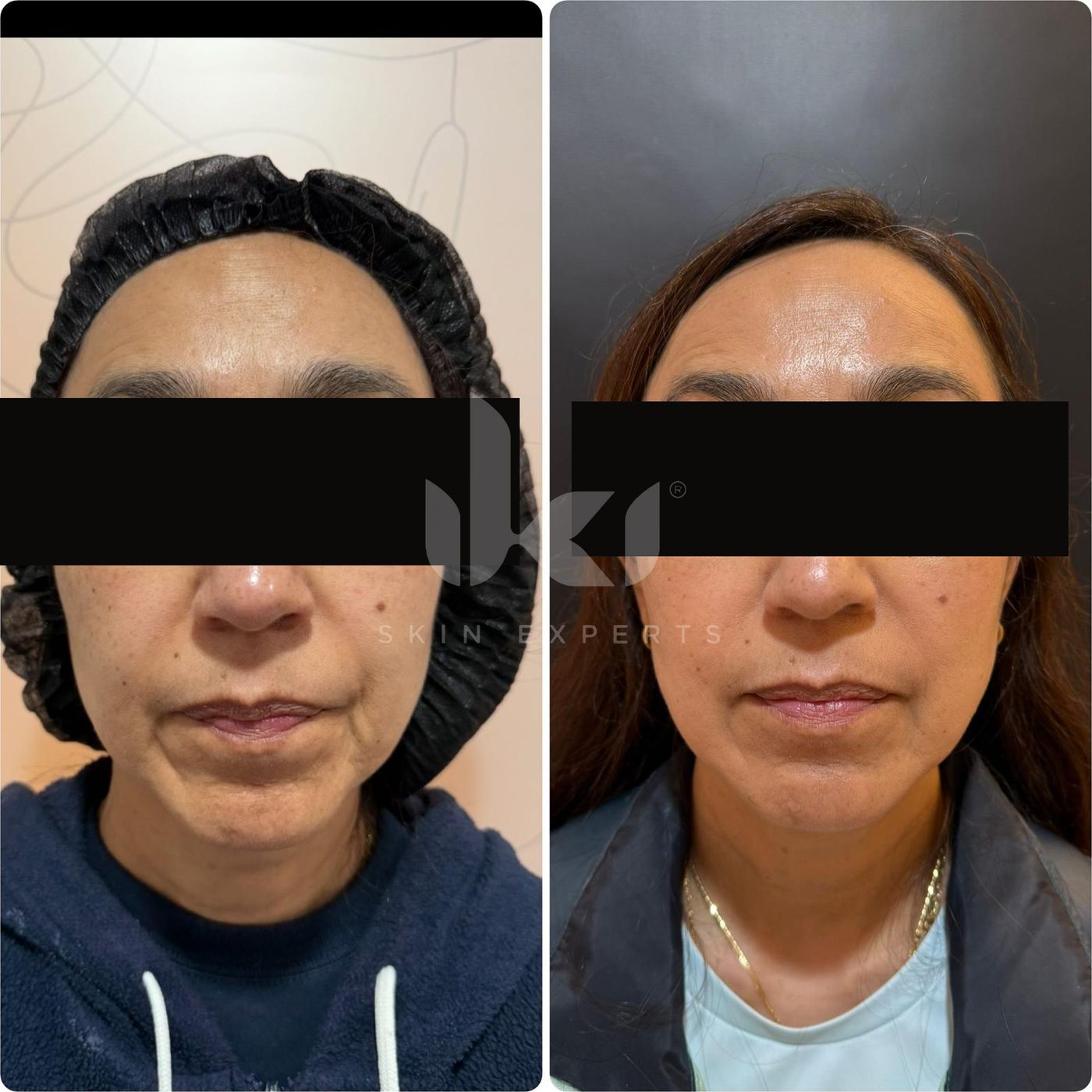 Antes y después de otros casos en IKI Skin Experts, caso 14, identidad protegida