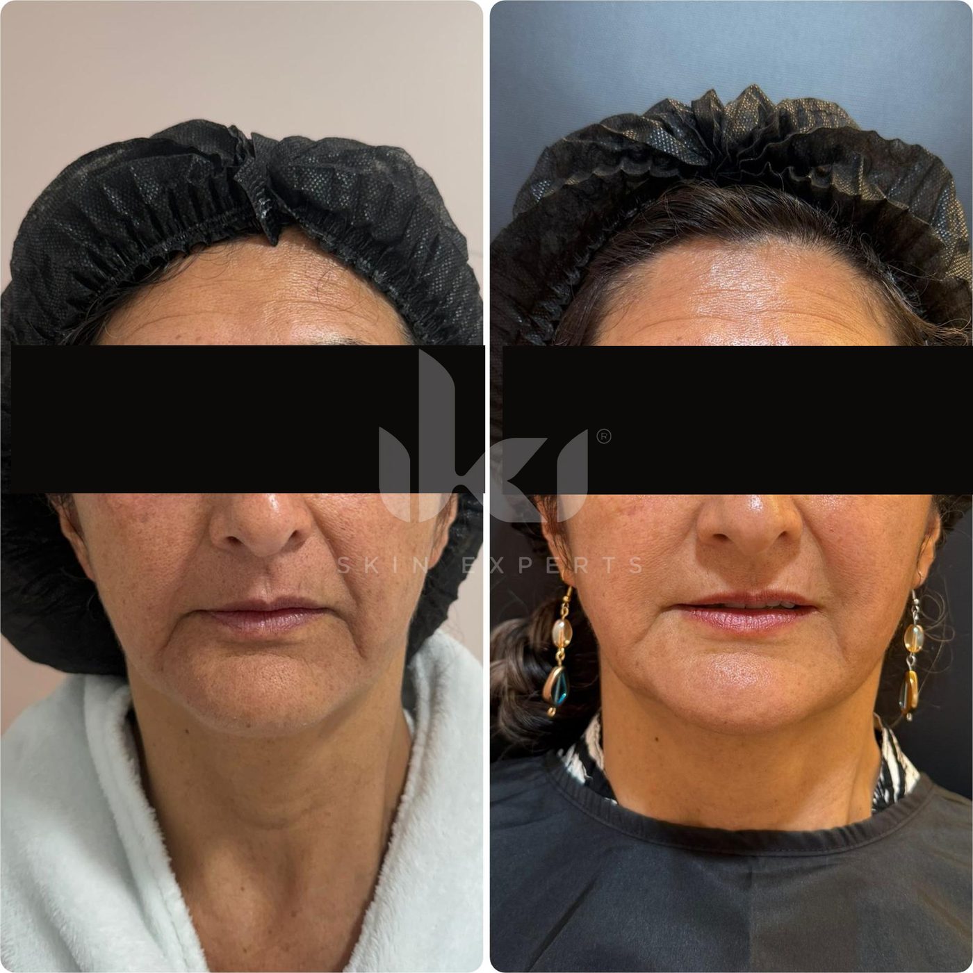 Antes y después de otros casos en IKI Skin Experts, caso 15, identidad protegida