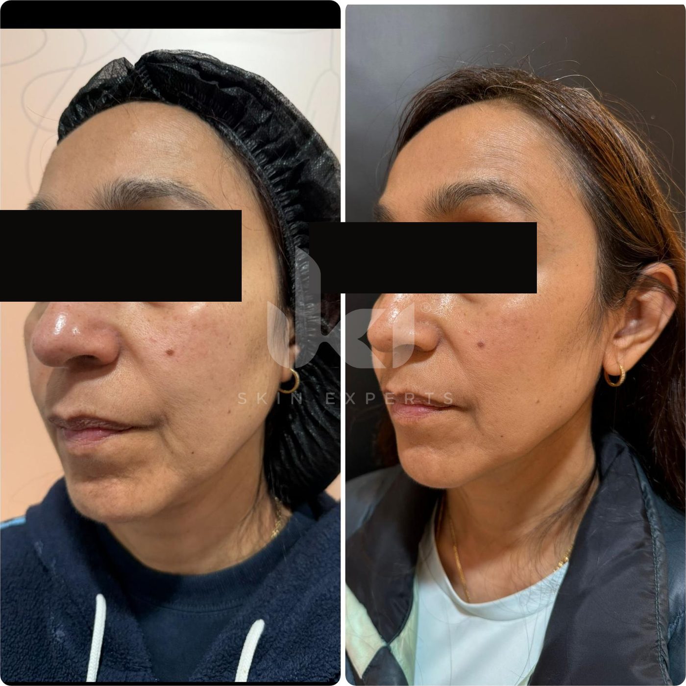 Antes y después de otros casos en IKI Skin Experts, caso 16, identidad protegida