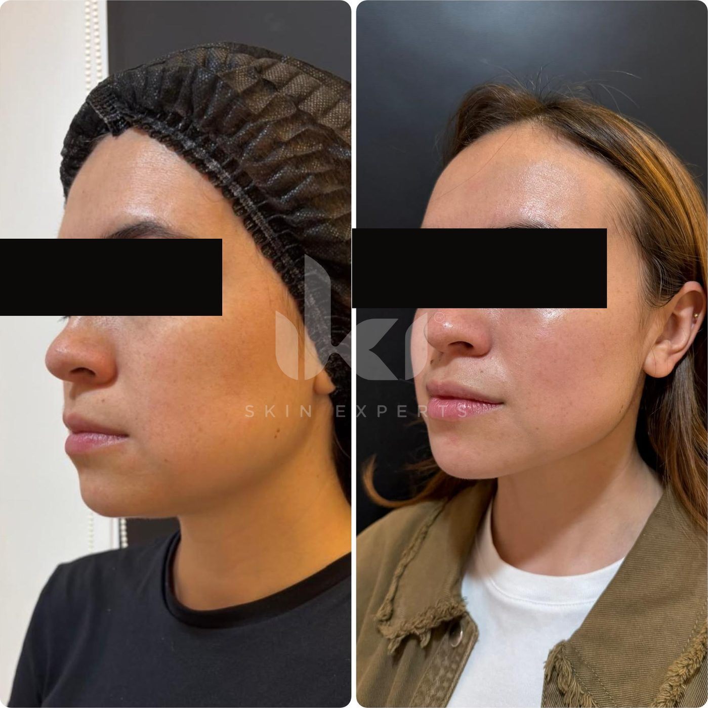 Antes y después de otros casos en IKI Skin Experts, caso 17, identidad protegida