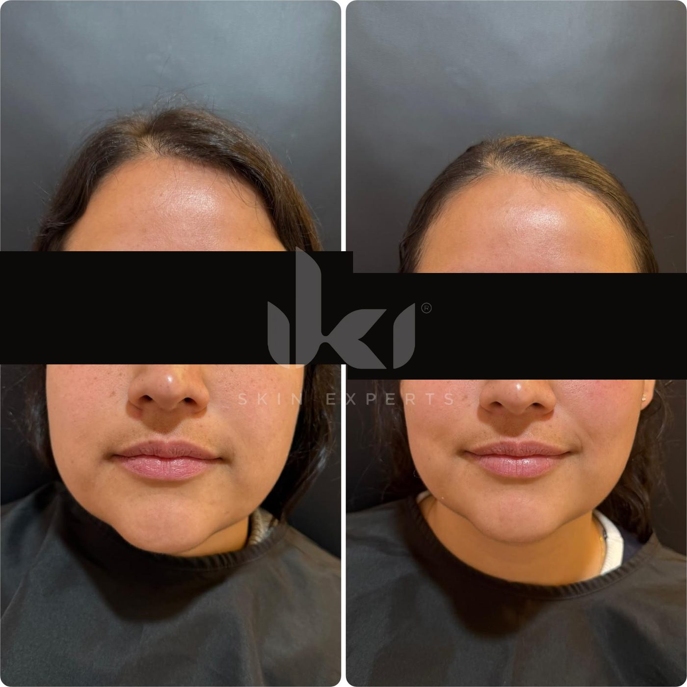 Antes y después de otros casos en IKI Skin Experts, caso 18, identidad protegida