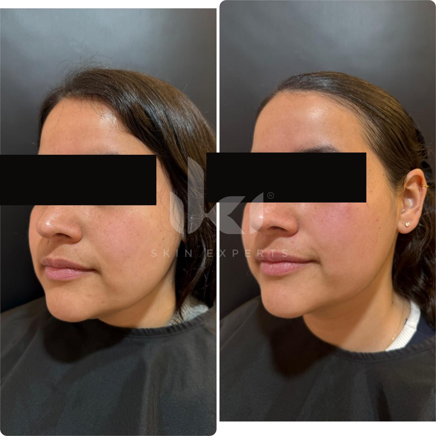 Antes y después de otros casos en IKI Skin Experts, caso 19, identidad protegida