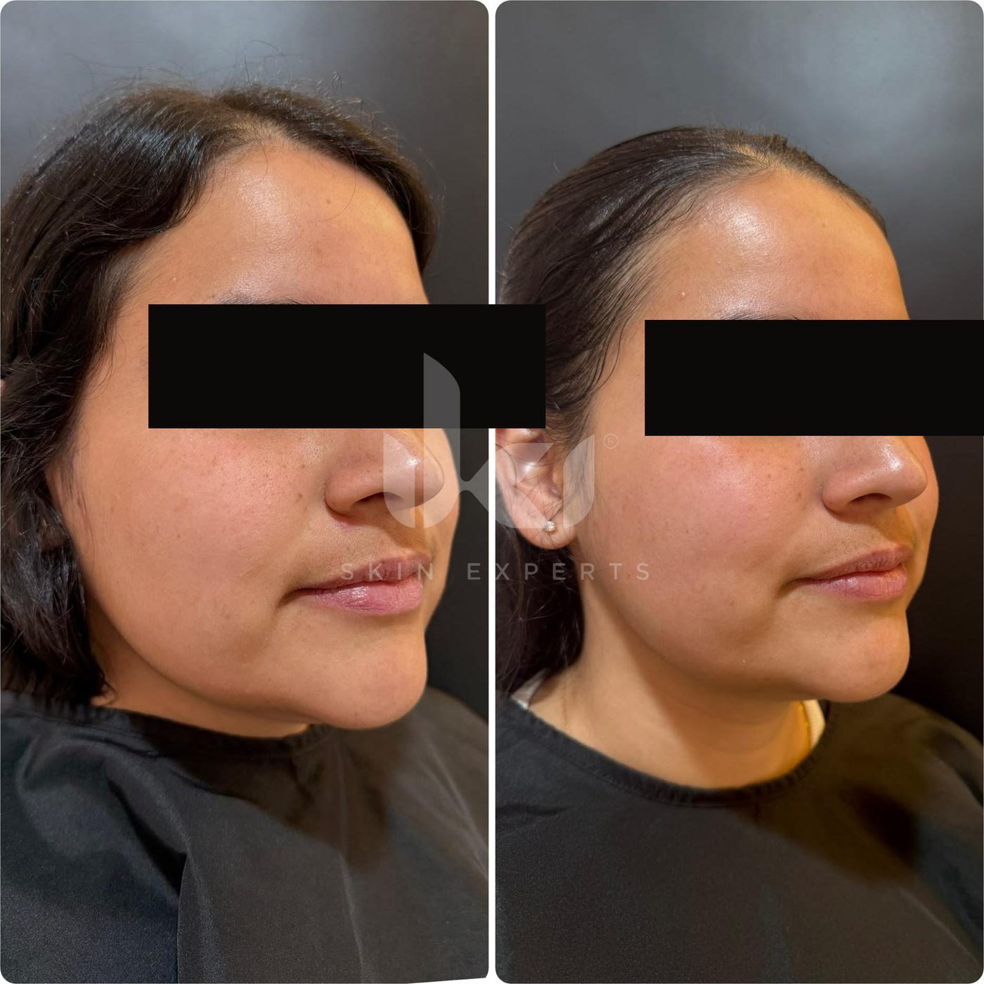 Antes y después de otros casos en IKI Skin Experts, caso 20, identidad protegida