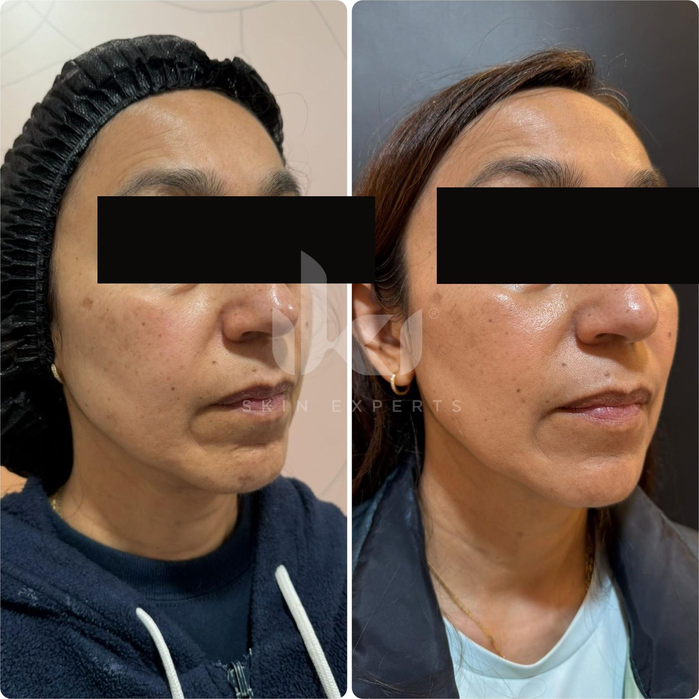 Antes y después de otros casos en IKI Skin Experts, caso 21, identidad protegida