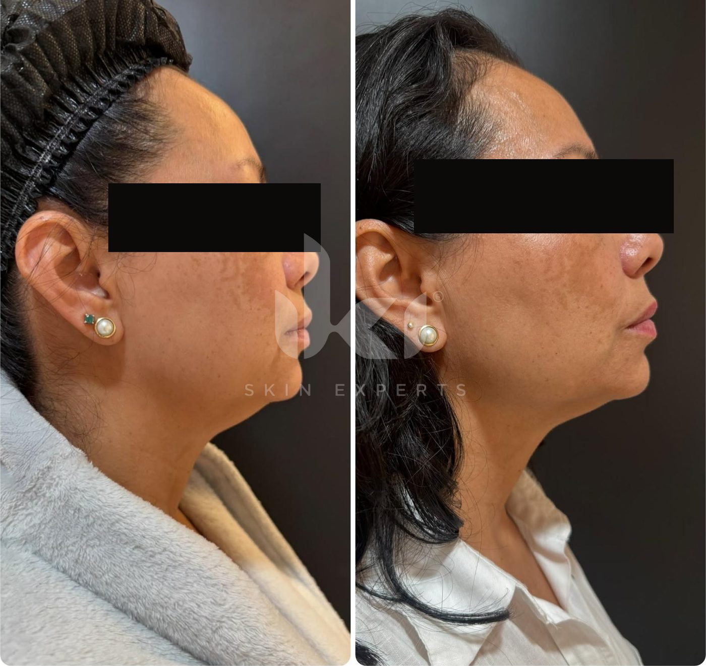 Antes y después de manchas y melasma en IKI Skin Experts, caso 50, identidad protegida