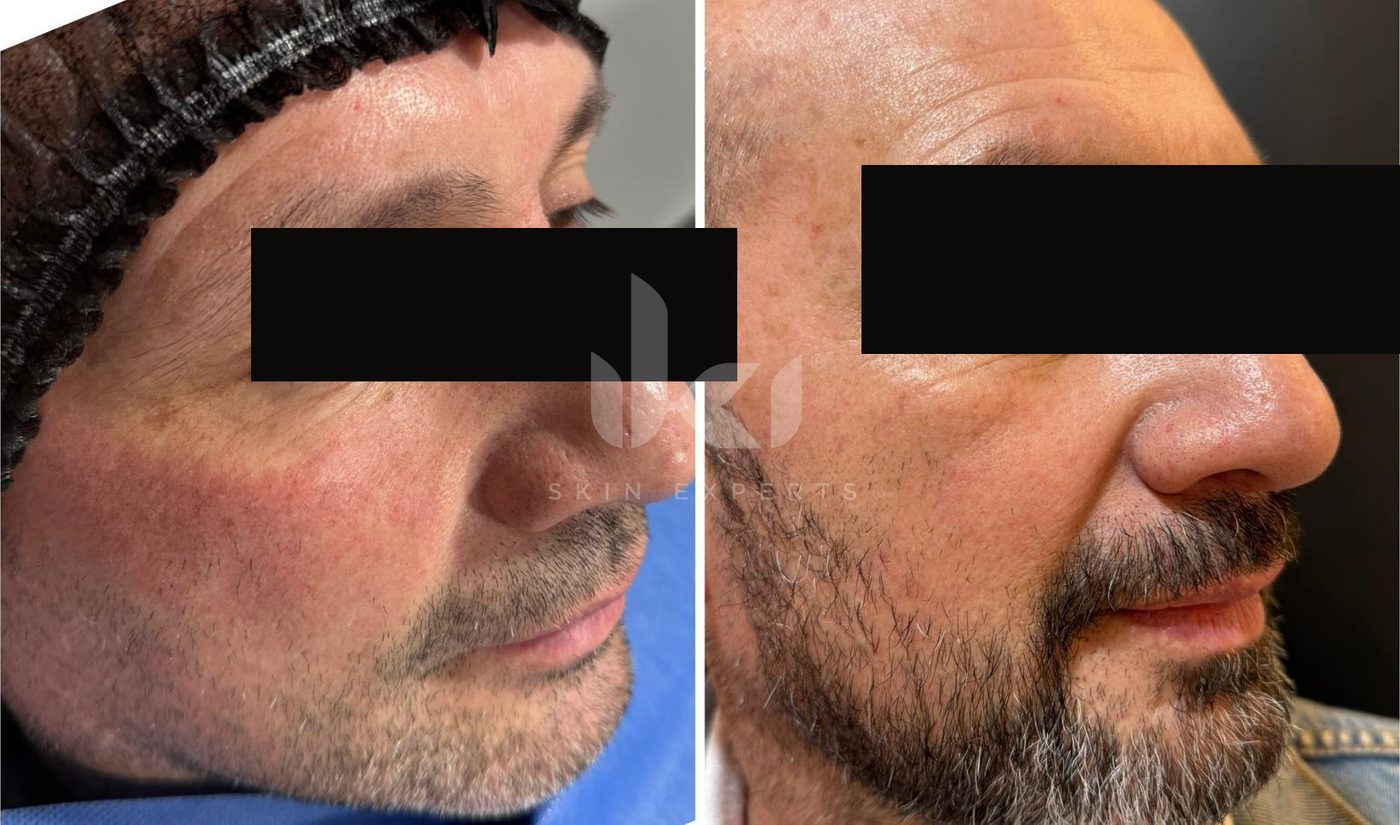 Antes y después de rosácea en IKI Skin Experts, caso 9, identidad protegida