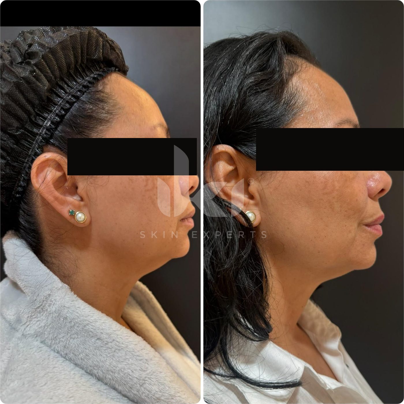 Antes y después de manchas y melasma en IKI Skin Experts, caso 51, identidad protegida