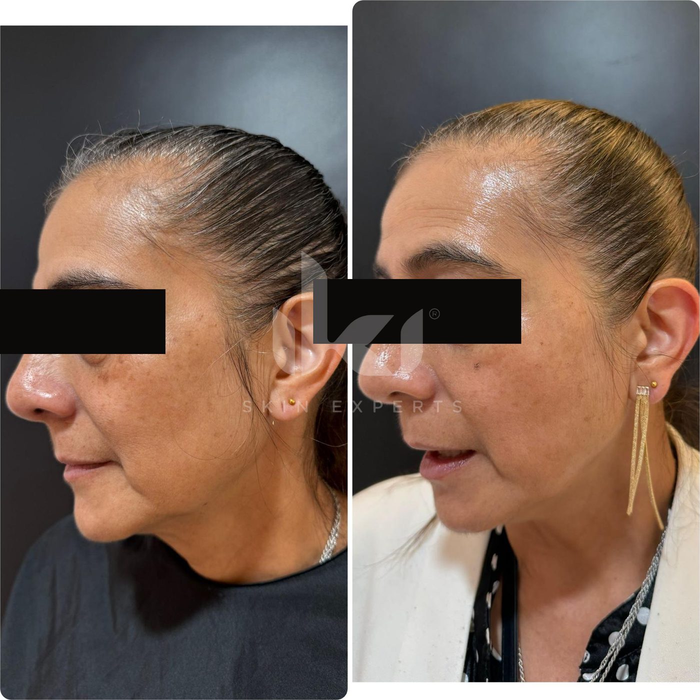Antes y después de manchas y melasma en IKI Skin Experts, caso 52, identidad protegida