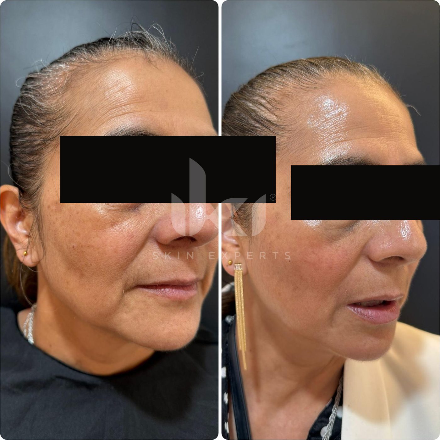 Antes y después de manchas y melasma en IKI Skin Experts, caso 53, identidad protegida