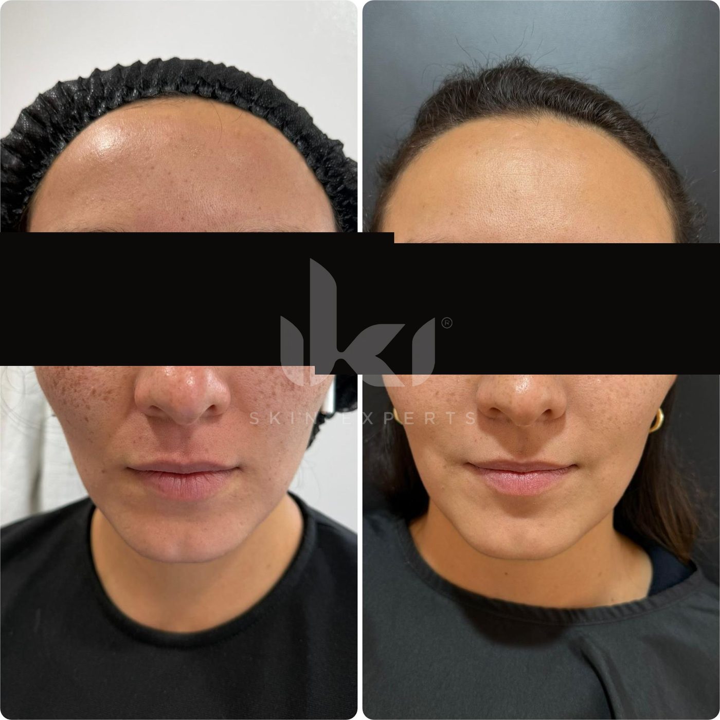 Antes y después de manchas y melasma en IKI Skin Experts, caso 54, identidad protegida