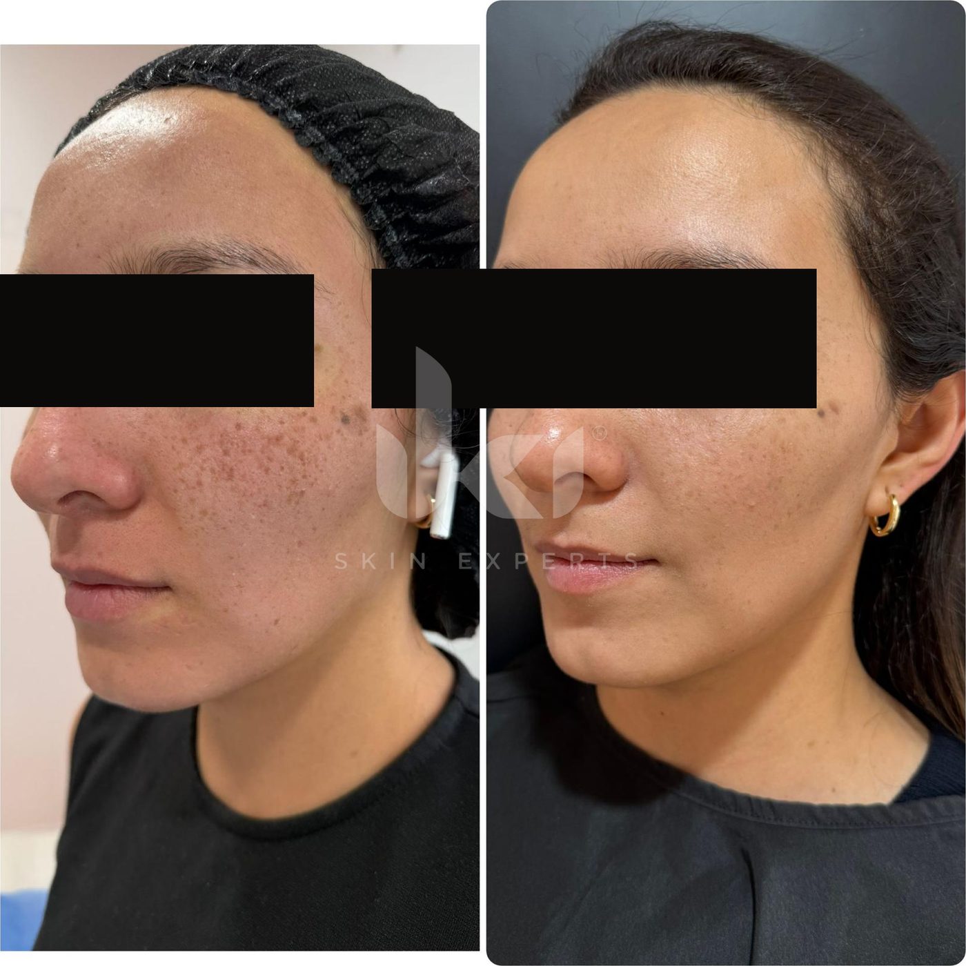 Antes y después de manchas y melasma en IKI Skin Experts, caso 55, identidad protegida