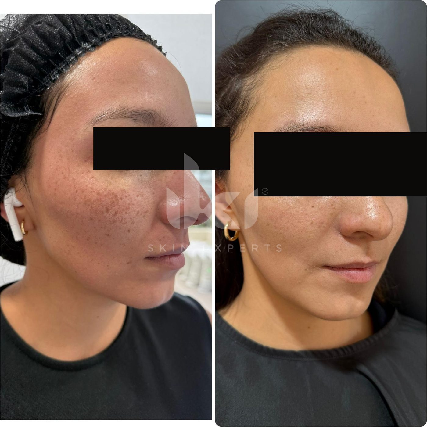 Antes y después de manchas y melasma en IKI Skin Experts, caso 56, identidad protegida