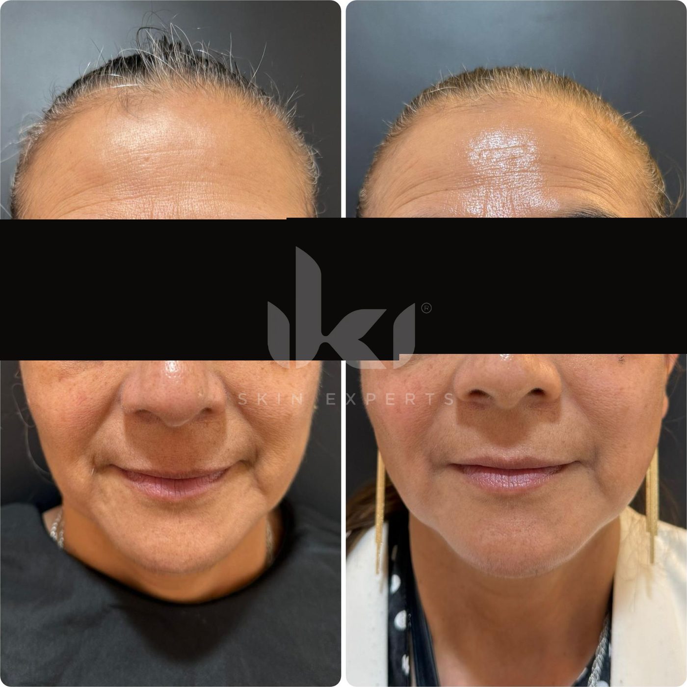 Antes y después de manchas y melasma en IKI Skin Experts, caso 57, identidad protegida
