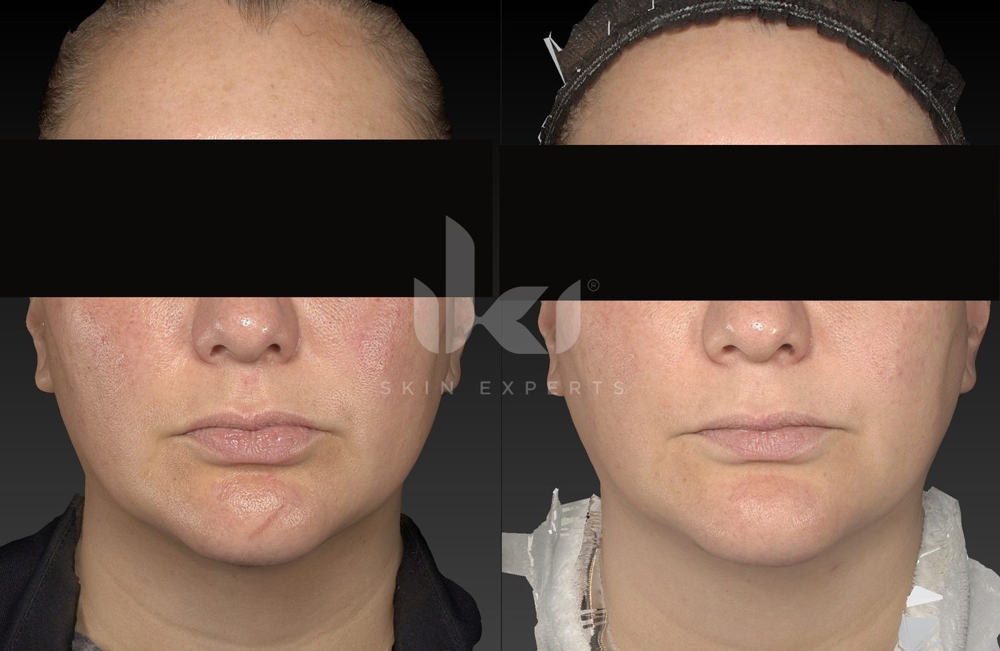 Antes y después de rosácea en IKI Skin Experts, caso 10, identidad protegida