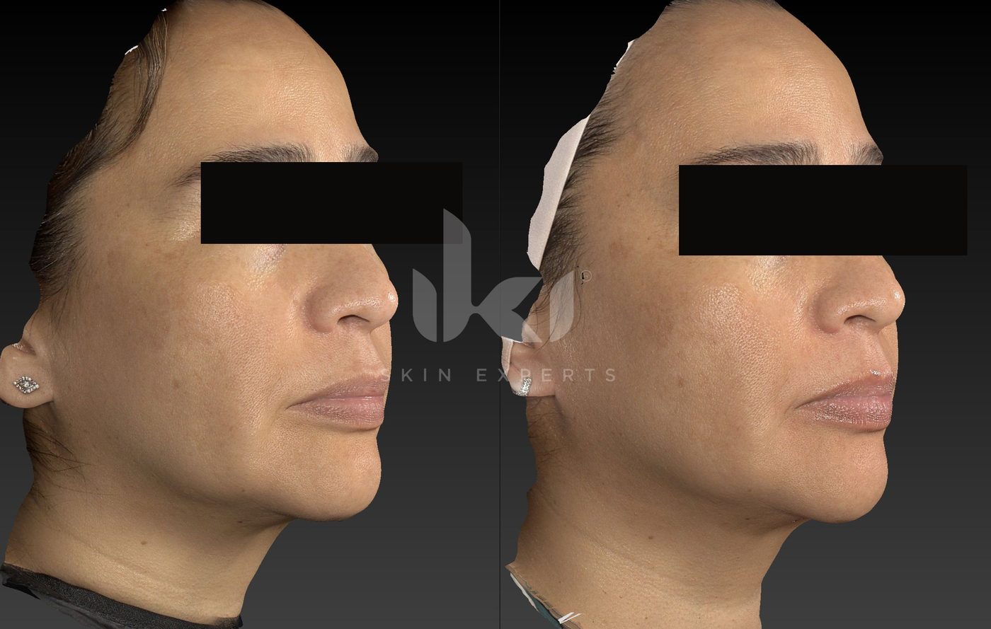 Antes y después de manchas y melasma en IKI Skin Experts, caso 58, identidad protegida