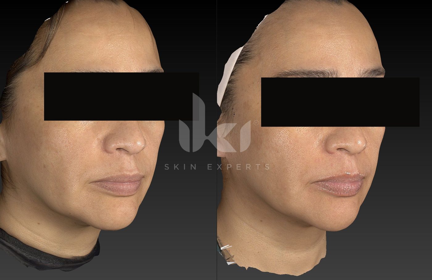 Antes y después de manchas y melasma en IKI Skin Experts, caso 59, identidad protegida