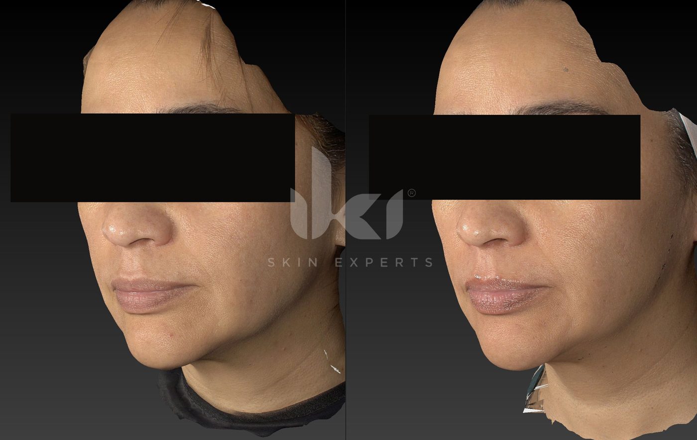 Antes y después de manchas y melasma en IKI Skin Experts, caso 60, identidad protegida