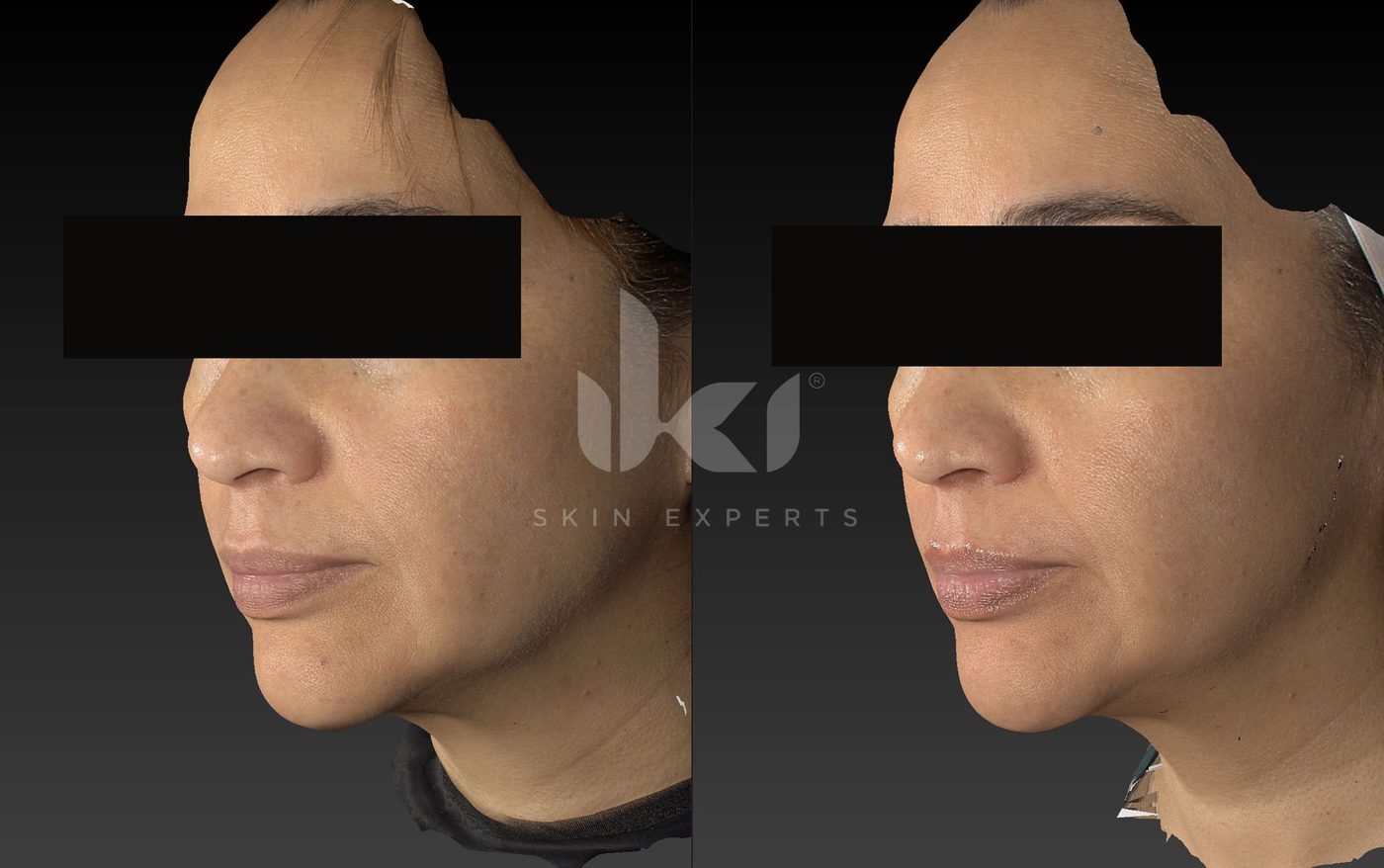 Antes y después de manchas y melasma en IKI Skin Experts, caso 61, identidad protegida