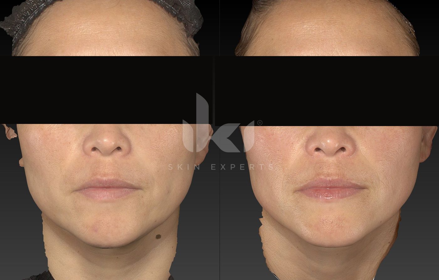 Antes y después de otros casos en IKI Skin Experts, caso 22, identidad protegida