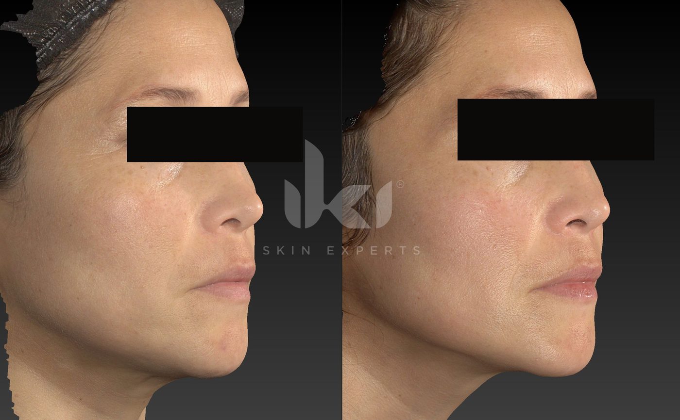 Antes y después de otros casos en IKI Skin Experts, caso 23, identidad protegida
