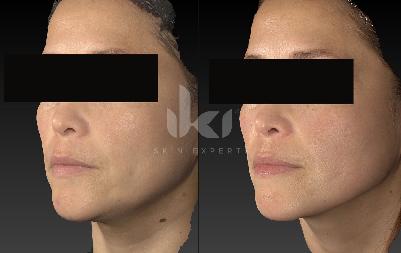 Antes y después de otros casos en IKI Skin Experts, caso 24, identidad protegida