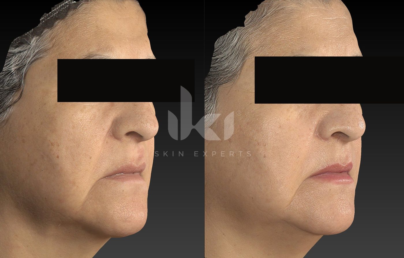 Antes y después de manchas y melasma en IKI Skin Experts, caso 62, identidad protegida