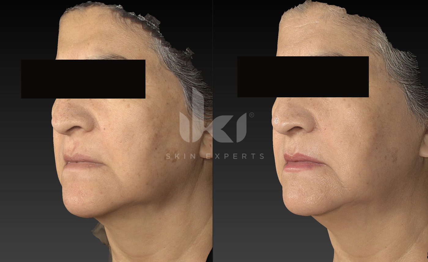 Antes y después de manchas y melasma en IKI Skin Experts, caso 63, identidad protegida