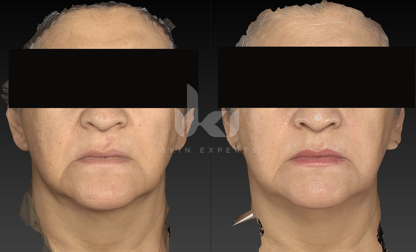 Antes y después de manchas y melasma en IKI Skin Experts, caso 64, identidad protegida