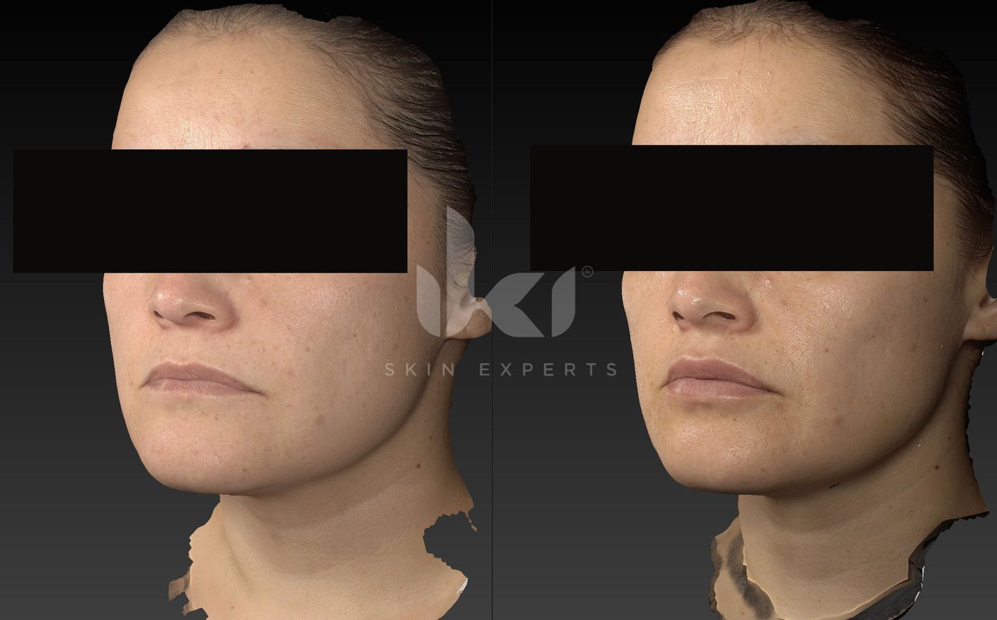 Antes y después de otros casos en IKI Skin Experts, caso 25, identidad protegida