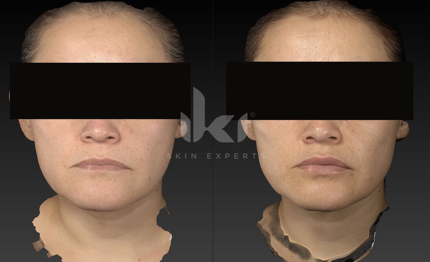 Antes y después de otros casos en IKI Skin Experts, caso 26, identidad protegida