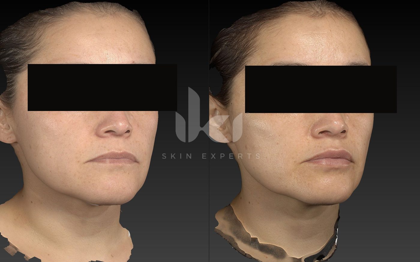 Antes y después de otros casos en IKI Skin Experts, caso 27, identidad protegida