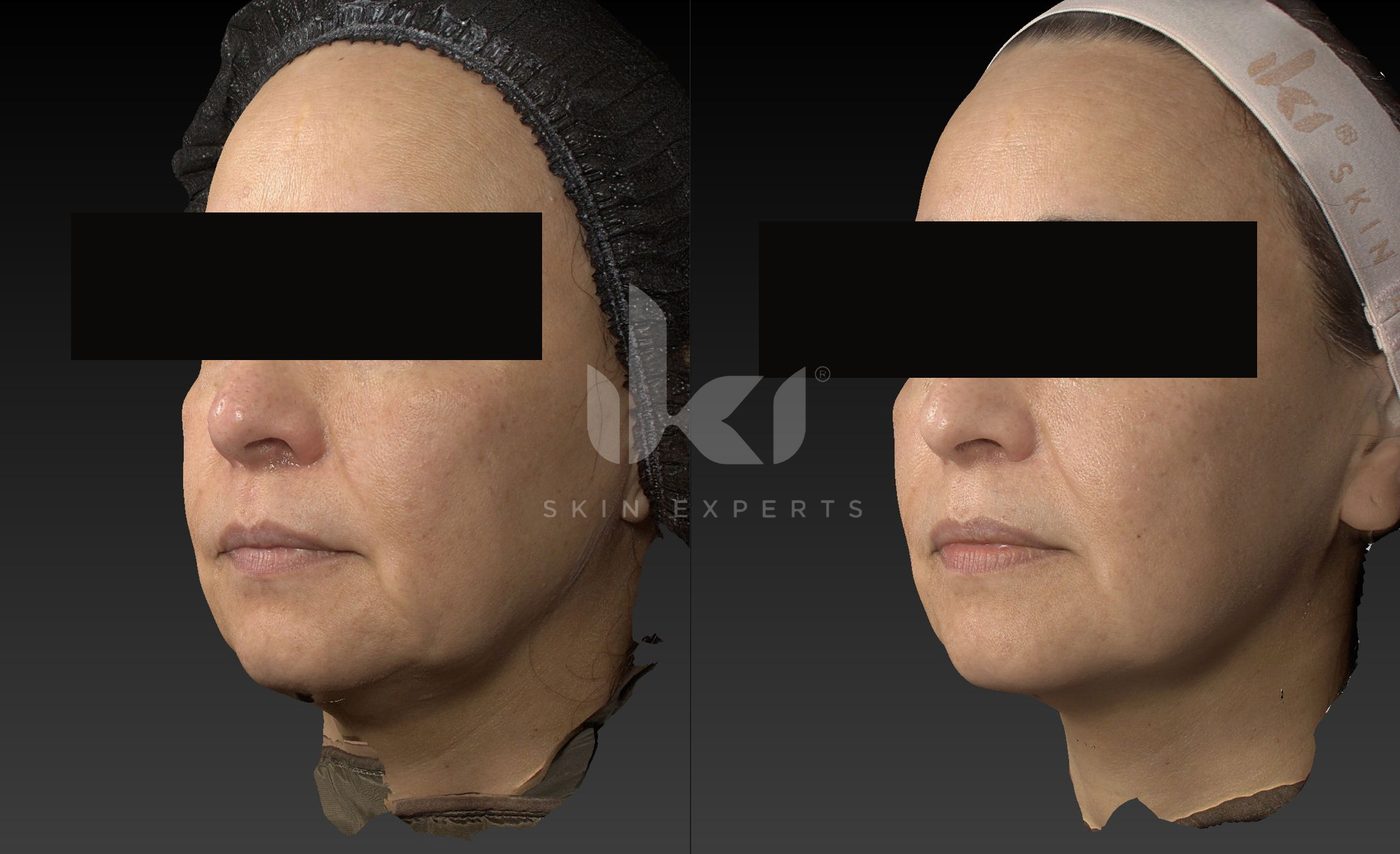 Antes y después de otros casos en IKI Skin Experts, caso 28, identidad protegida