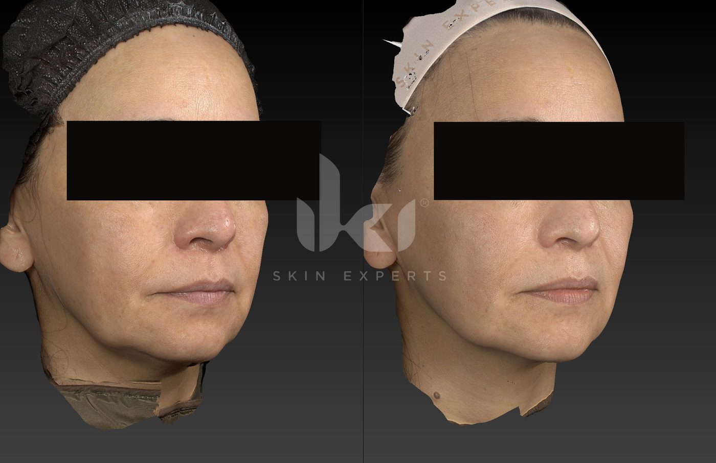 Antes y después de otros casos en IKI Skin Experts, caso 29, identidad protegida